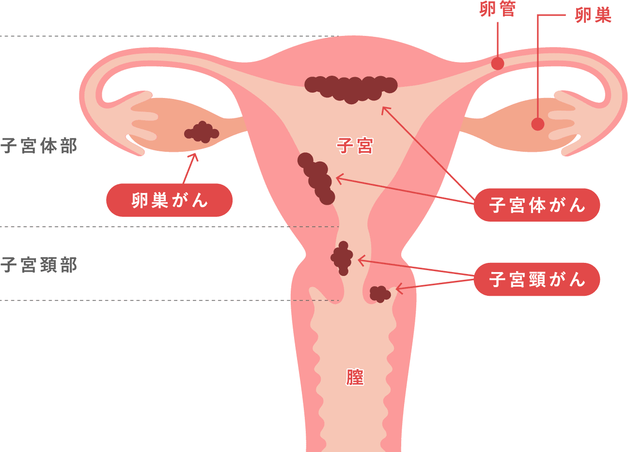 がん検診